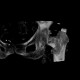 Pertrochanteric fracture, hardware migration, non-union, VRT: CT - Computed tomography